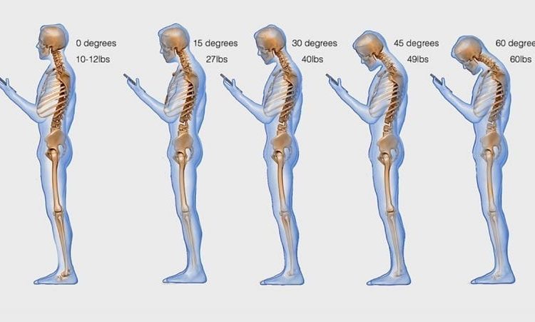  Text neck syndrome o collo da smartphone
